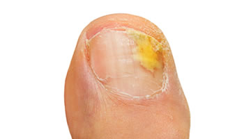 Fungal Nail problems