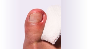 In-growing toenail treatment