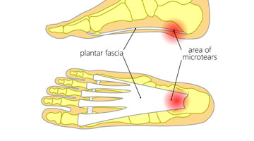 Help for Plantar Fasciitis foot condition